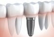 Implant Dentar Brasov