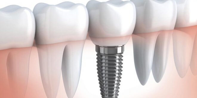 Implant Dentar Brasov